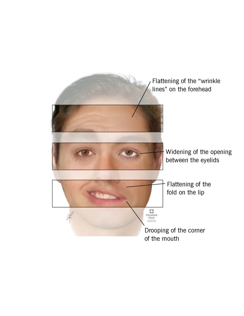 Gesichtslähmung | Akupunktur bei Gesichtslähmung