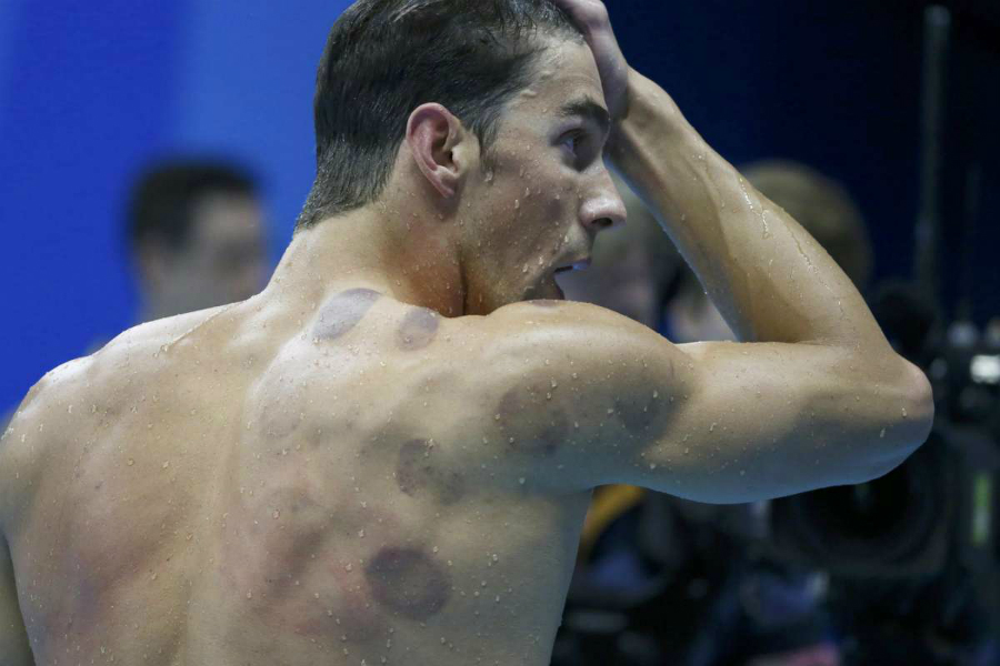 Schwimmer Michael Phelps bei den Olympischen Spielen 2016 mit runden Schröpfmalen auf Schulter und Rücken