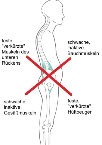 Schema des Lower Crossed Syndroms: verkürzte Muskeln des unteren Rückens und Hüftbeuger, abgeschwächte Bauch- und Gesässmuskeln