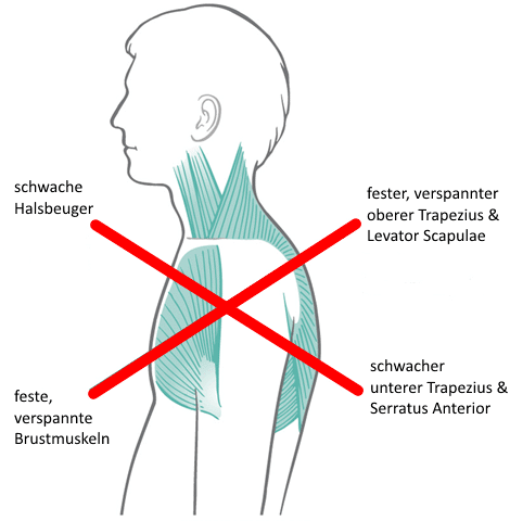 Schema des Upper Crossed Syndroms: verspannter oberer Trapezius und Brustmuskeln, abgeschwächte Halsbeuger